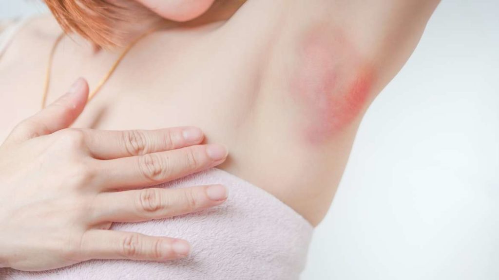 Teve alergia nas axilas? Pode ser culpa do desodorante - Alegocare -  Clínica de Alergia e Imunologia em Goiânia
