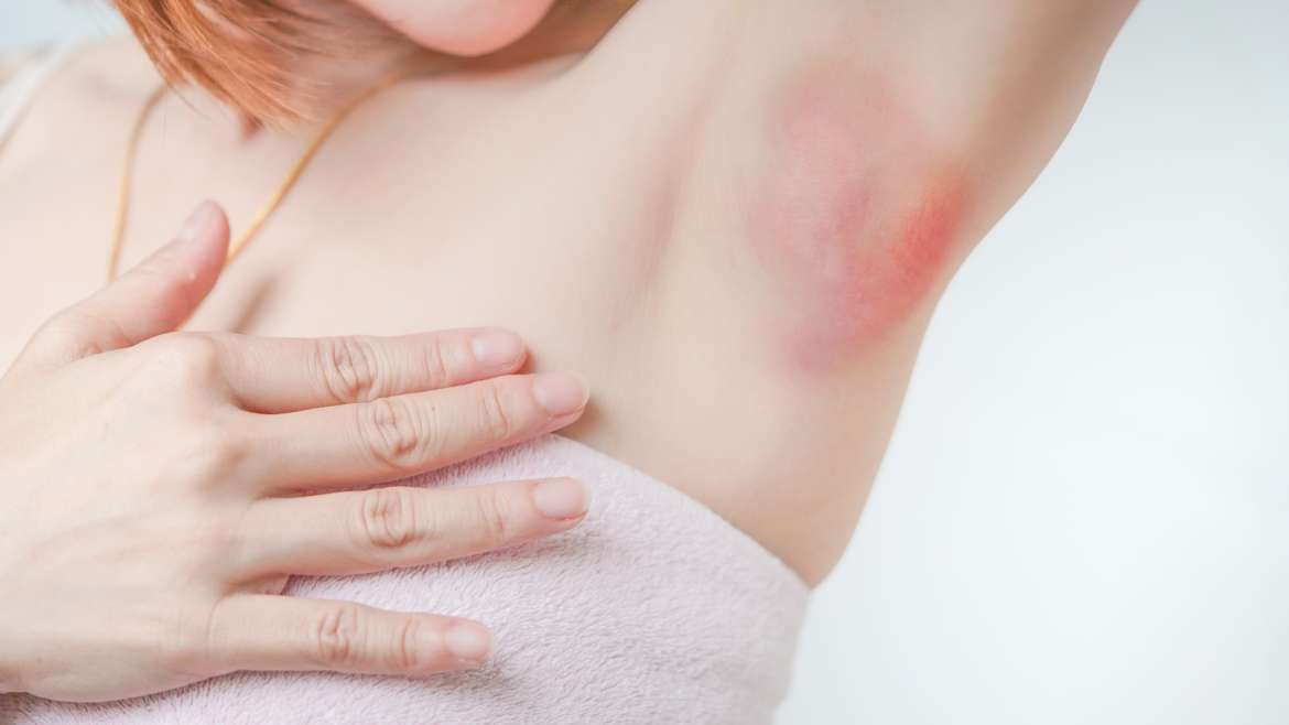 Doenças na pele das axilas: 7 principais tipos 