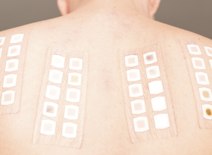 patch test aplicado sobre as costas do paciente