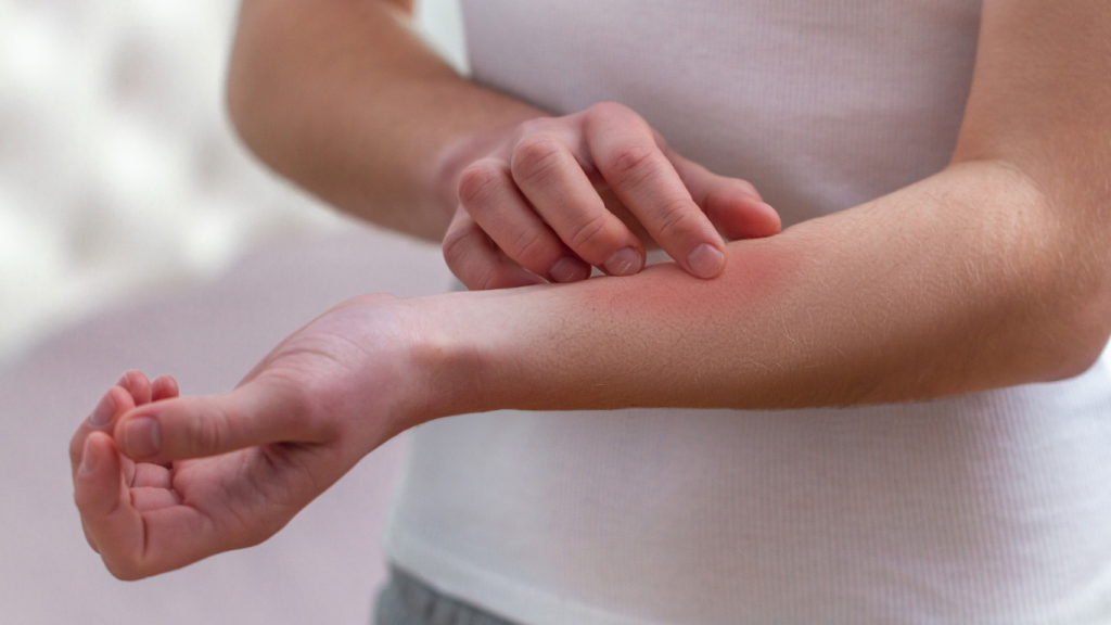 Moça coçando o braço, com sintomas de alergia ao látex